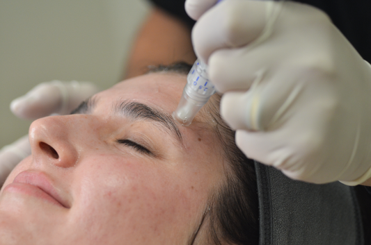Introducing SkinPen: A look at the benefits of Microneedling