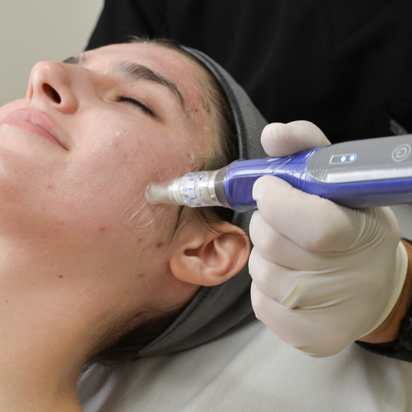 Summer Social Special: SkinPen (Package of 3)