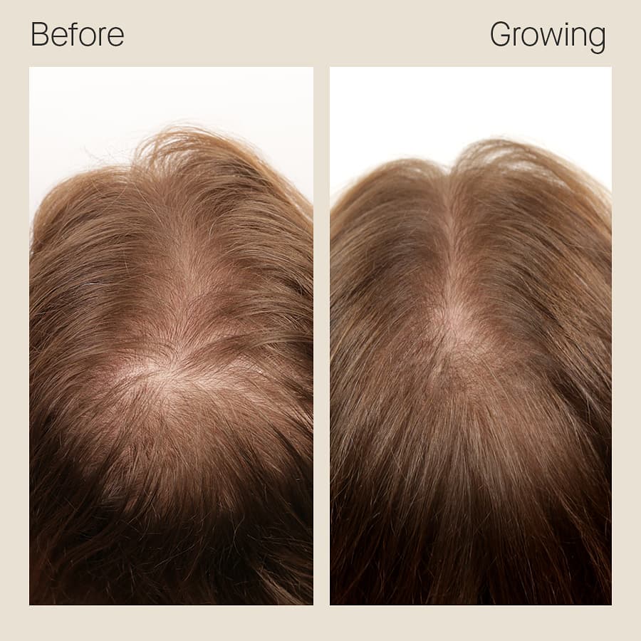 Nutrafol Women Hair Growth Pack (Ages 18-44)