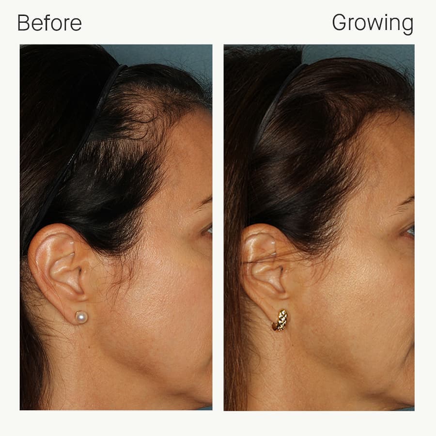 Nutrafol Women Hair Growth Pack (Ages 18-44)
