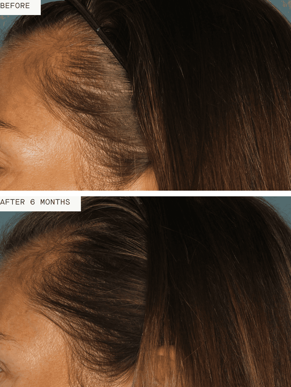Nutrafol Women Hair Growth Pack (Ages 18-44)