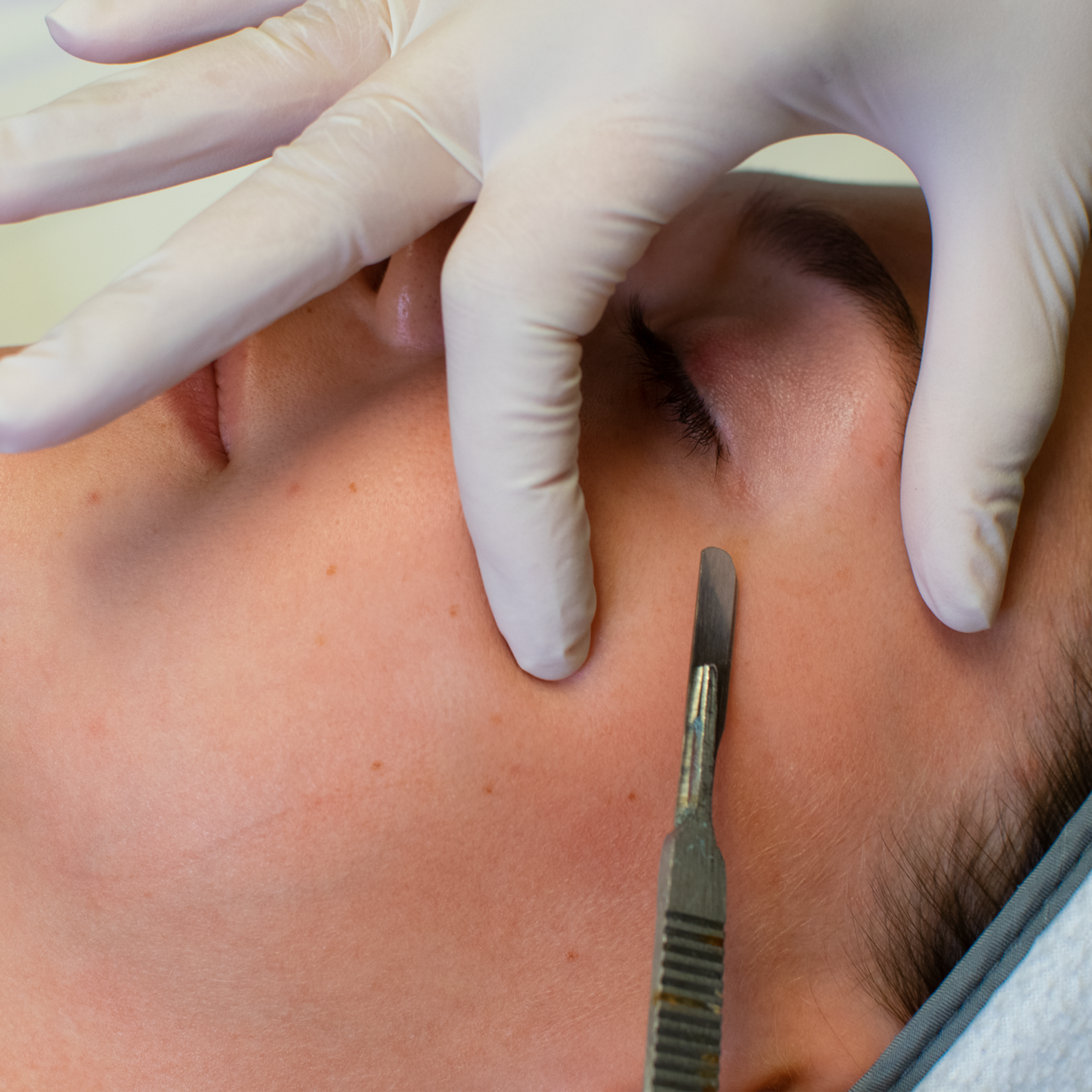 Summer Social Special: Dermaplaning Packages